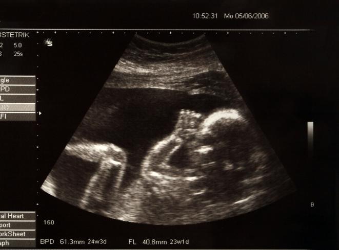 25 Недель Беременности Фото Ребенка На Узи